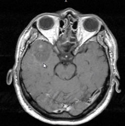 Grade II Astrocytoma is less dense than surrounding tissue