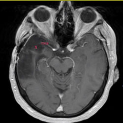 Grade II Astrocytoma MRI looks similar to brain tissue