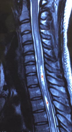 The syringomyelia appears on the MRI.