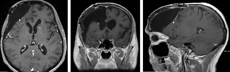 MRI Mixed Oligodendroglioma-Astrocytoma patient 7 years after treatment